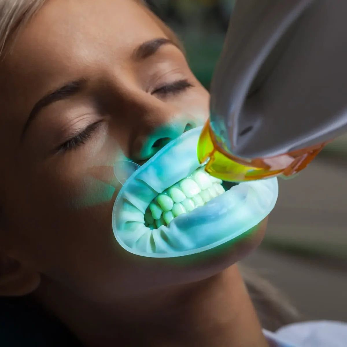 66291bc60b0e21dfcee73d9f_Professional teeth whitening in Jensen Beach FL